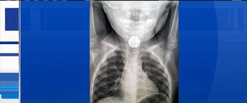 X-ray shows battery stuck in toddler&#039;s esophagus