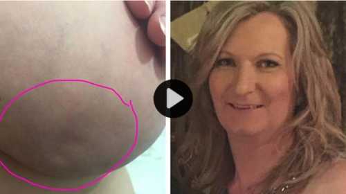 Skin dimpling sign of breast cancer.