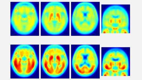 PET scans: healthy brain (top), Alzheimer&#039;s (bottom) - Red areas indicate tau deposits.