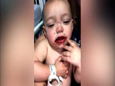 Baby Juliano, suffering from cold sores