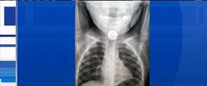 X-ray shows battery stuck in toddler\'s esophagus
