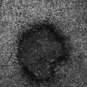 Bottom right corner of Nia Payne's left eye now contains cellular damage in the form of a crescent-shaped chip.