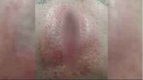 Brown recluse spider bite