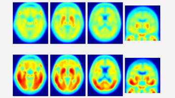 PET scans: healthy brain (top), Alzheimer's (bottom) - Red areas indicate tau deposits.