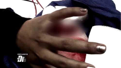 Chelsey's finger injury after ring gets caught on fence