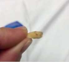 Tooth found in cashews